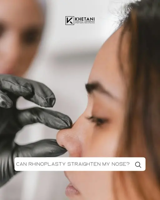 An Instagram card showing a nose in profile beside the question, can rhinoplasty straighten my nose.